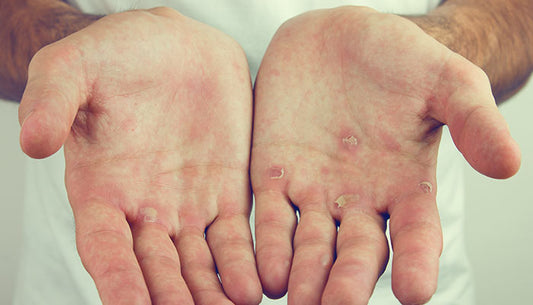 Que faire en cas de cloque ?